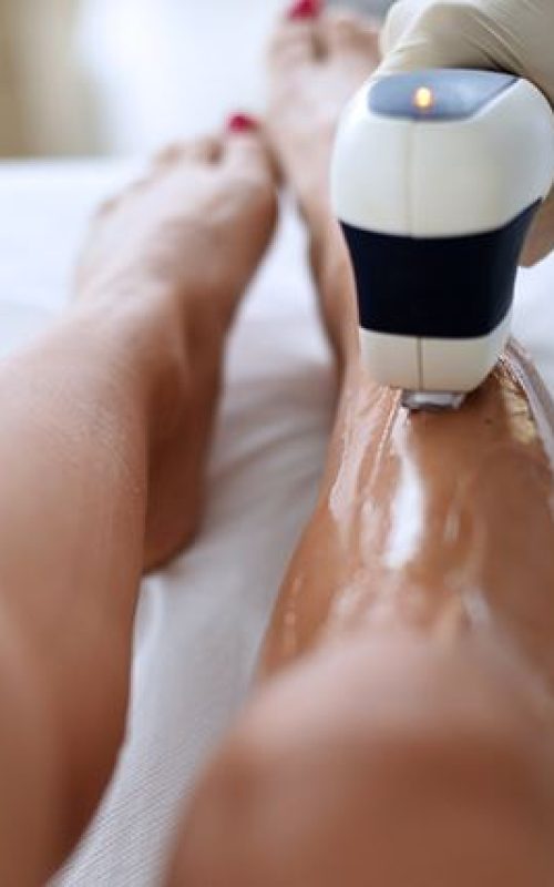 epilazione epilazione